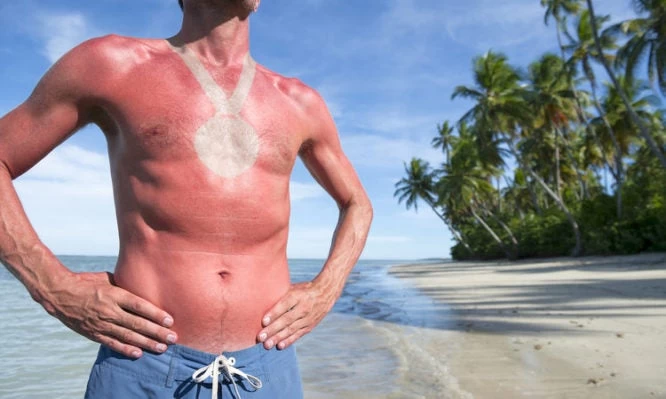 Πώς θα νικήσετε τα ηλιακά εγκαύματα σε πέντε βήματα